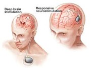 Η νέα επαναστατική μέθοδος της Εγκεφαλικής Νευροδιέγερσης
