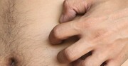 Δερματικές παθήσεις.
Υπάρχουν πολλές δερματικές παθήσεις που μπορεί να προκαλέσουν φαγούρα. Η ροδόχρους πιτυρίαση είναι μια δερματική πάθηση που αρχίζει με ερυθρότητα, φαγούρα, και ξεφλούδισμα στο δέρμα στο στομάχι ή στην κοιλιά και στη συνέχεια εξαπλώνεται. Το προσβεβλημένο δέρμα μπορεί να γίνει κόκκινο ή καφέ. 