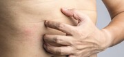 Εγκυμοσύνη
Πολλές γυναίκες έχουν φαγούρα στο δέρμα κατά τη διάρκεια της εγκυμοσύνης, ιδιαίτερα στις περιοχές όπου το δέρμα τεντώνει στο έπακρο, όπως στο στομάχι, τους μηρούς και τους γλουτούς. Περίπου το 1% των εγκύων γυναικών βιώνουν έντονη φαγούρα στο δέρμα που συνοδεύεται από ερυθρότητα και εξανθήματα.
